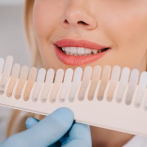 cropped view of male dentist matching teeth color of woman with palette in clinic, teeth whitening