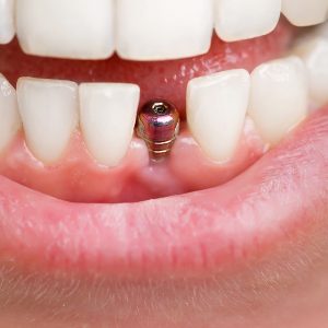 Dentist tools. Beautiful young woman smile with closeup of tooth implant for healthcare design. Healthy teeth. Orthodontic treatment. Dental care.