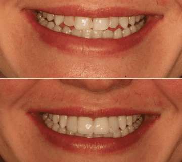 Black Minimalist Lip filler Quote Instagram Post 360x320