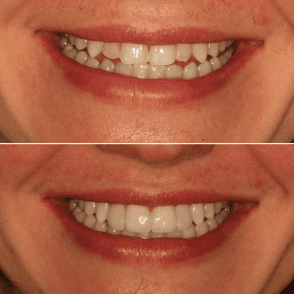 Black Minimalist Lip filler Quote Instagram Post