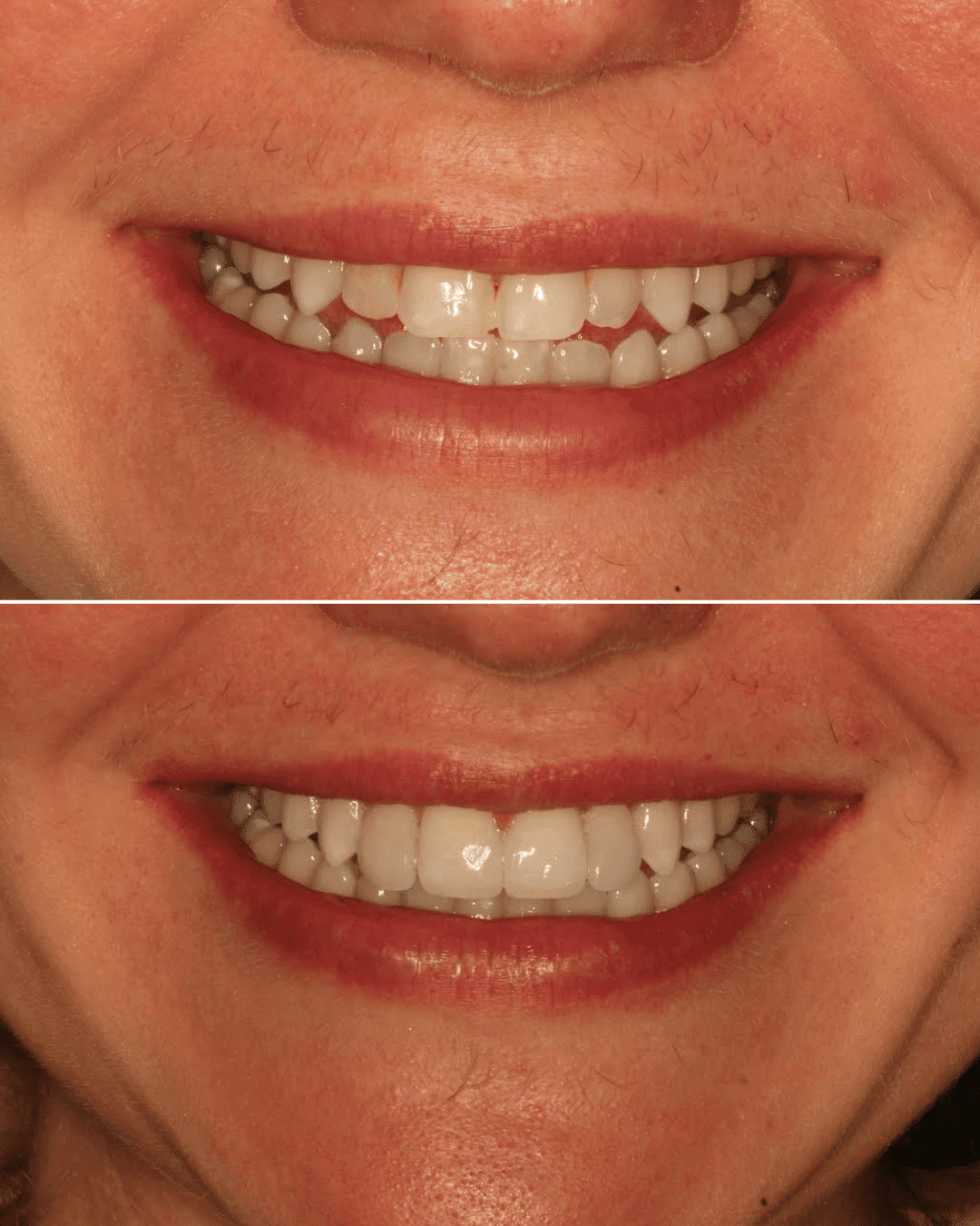 Black Minimalist Lip filler Quote Instagram Post